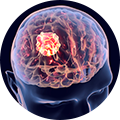 علاج اورام الدماغ
